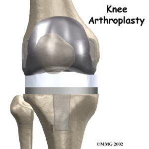knee_arthroplasty_intro01.jpg